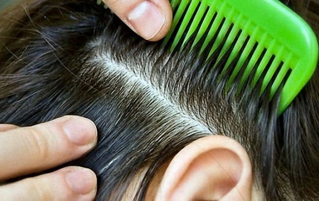 Лікар розповіла, що робити, якщо у дитини виявлено воші