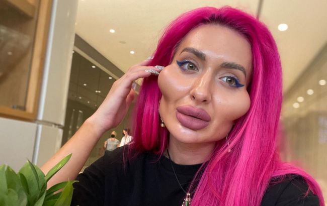 Эпатажная украинская блогер с гигантскими скулами еще больше "выросла": фото до и после