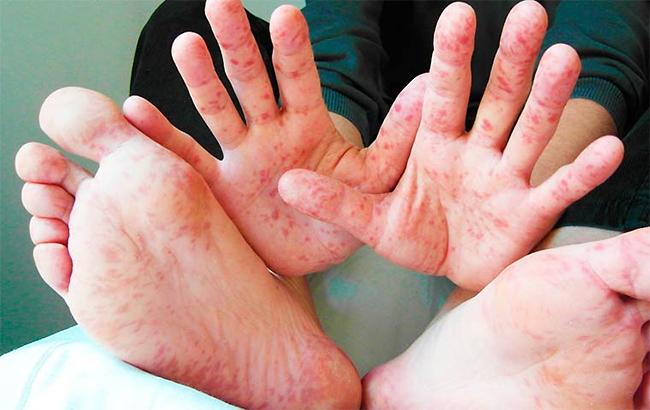 Спалах кору в Україні: у Львівській області захворіли 18 людей