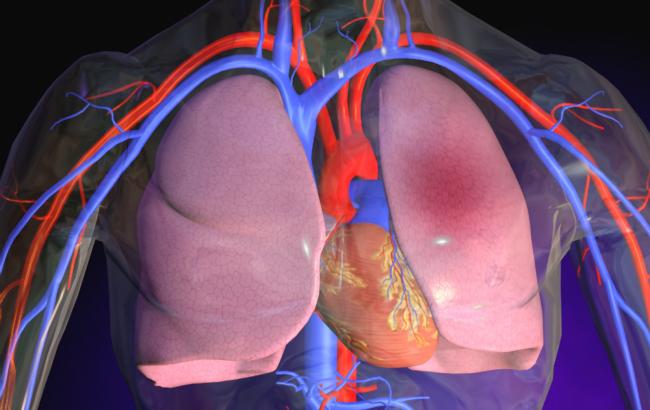 Что такое артериальная эмболия?