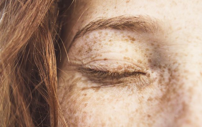 Врач назвал самую главную опасность веснушек