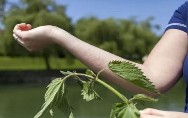 Як зняти опік від кропиви підручними засобами, якщо аптеки немає поруч